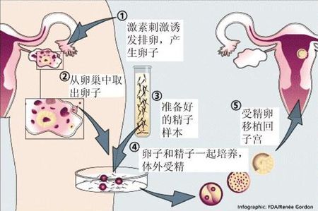 关于北京助孕包成功服务